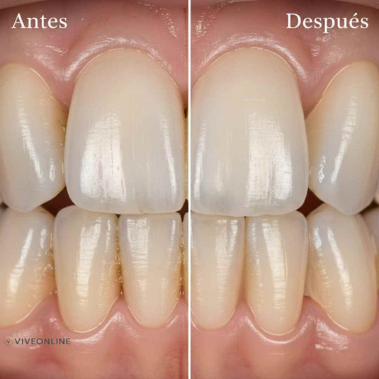 Kit Limpiador Dental Ultrasónico